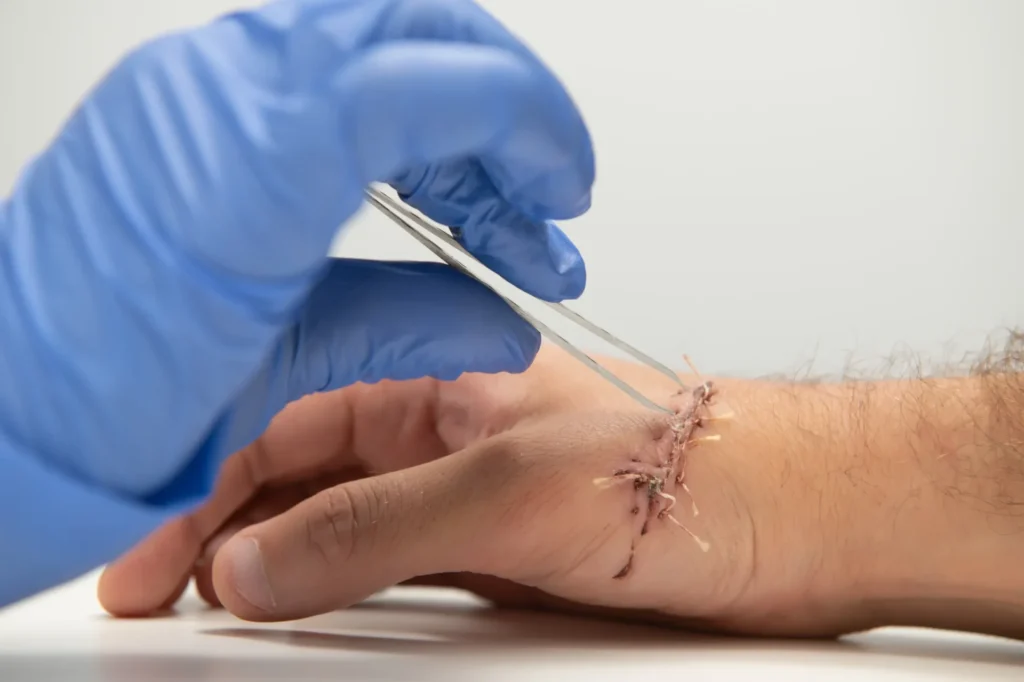 removing stitches from patient’s hand using tweezers, close-up of healing wound with sutures and medical gloves